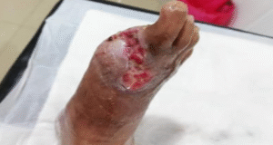 Área de la herida desinfectada tras el desbridamiento biológico con larvas de Lucilia sericata, mostrando tejido limpio y en recuperación.