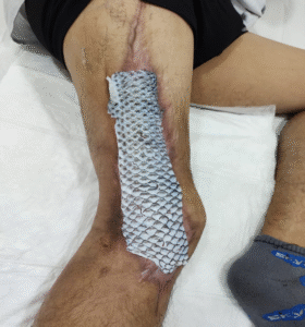 tratamiento de piel de tilapia