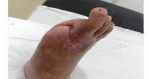 Formación de tejido de granulación en una herida tratada con larvas de Lucilia sericata, favorecida por secreciones larvales.