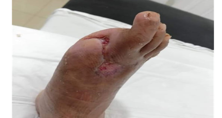 Formación de tejido de granulación en una herida tratada con larvas de Lucilia sericata, favorecida por secreciones larvales.